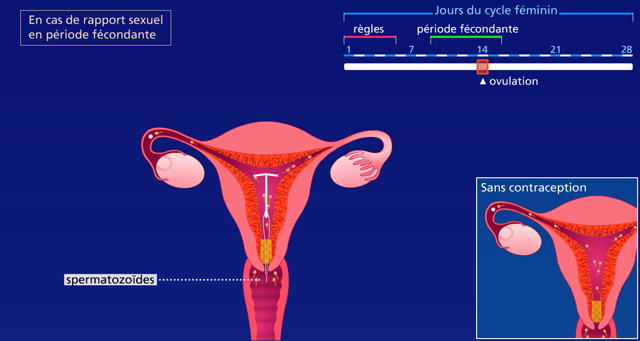 Pod - Mode D'Action Du Stérilet